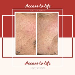 Access to life Microdermabrasie voor en na