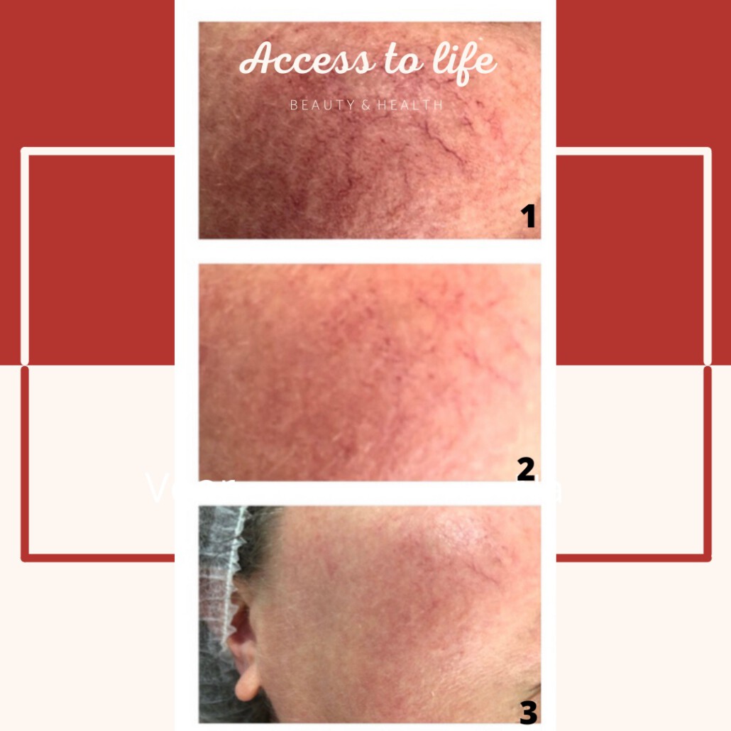 Rosacea en couperose Access to life