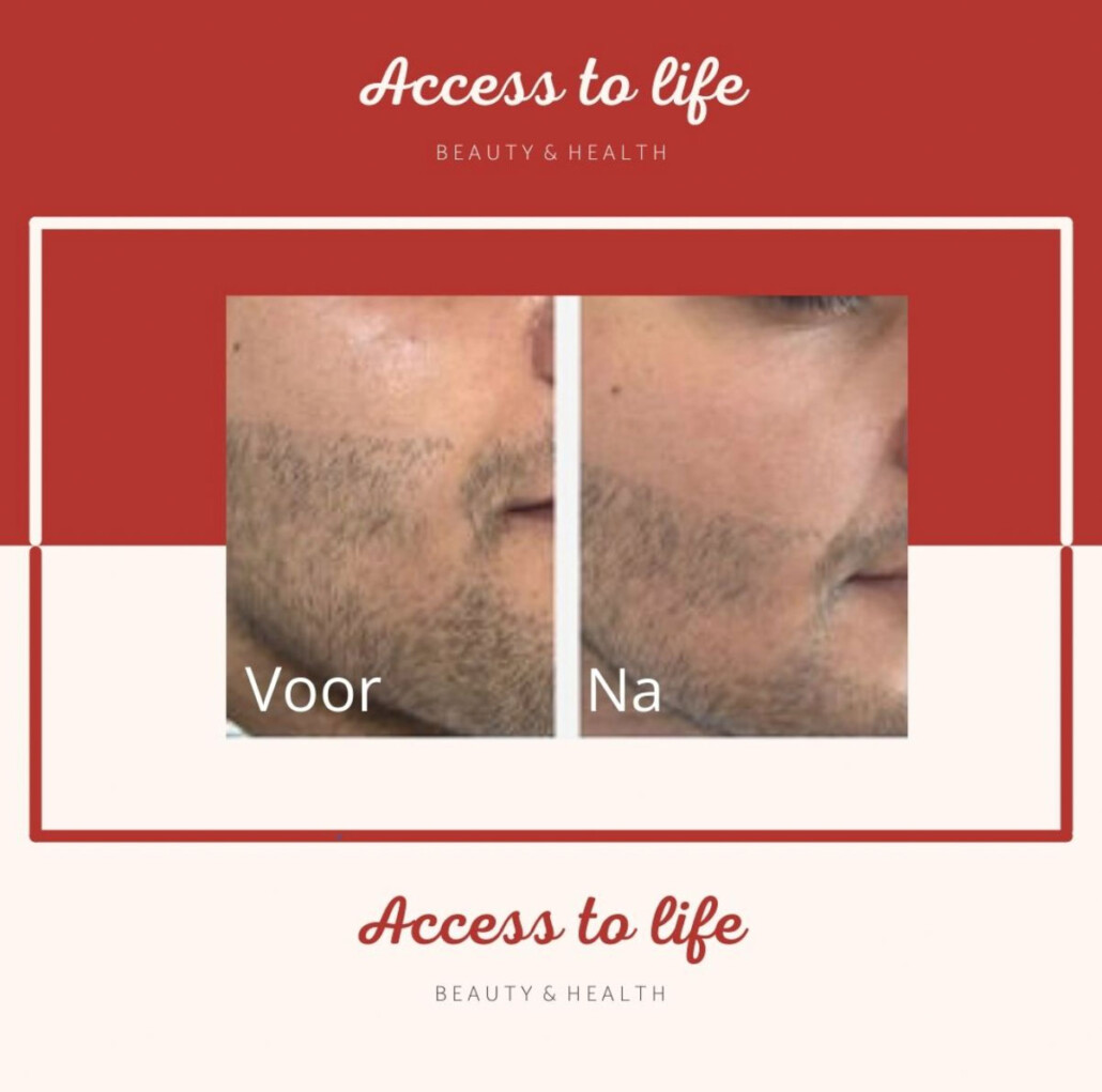 microdermabrasie bij Access to life